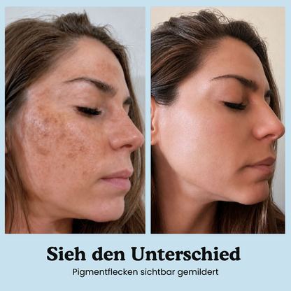 Anti-Pigmentflecken-Kapseln
