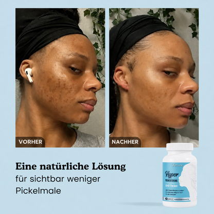 Hyperpigmentierung Anti-Flecken Kapseln