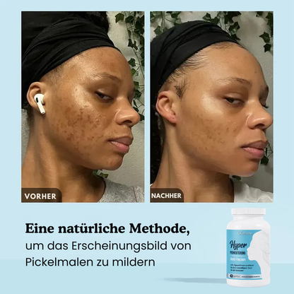Anti-Pigmentflecken-Kapseln